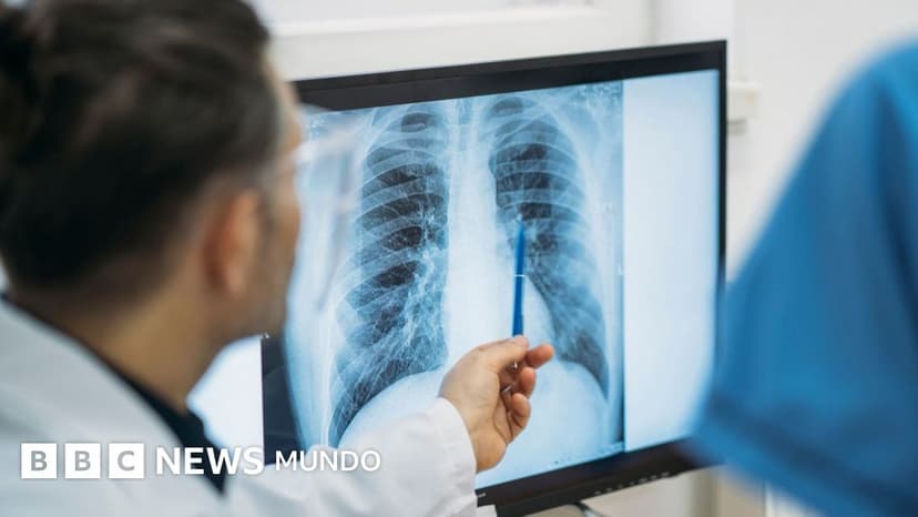 Qué es un adenocarcinoma pulmonar, el tipo de tumor maligno que le extirparon al papa León XIV